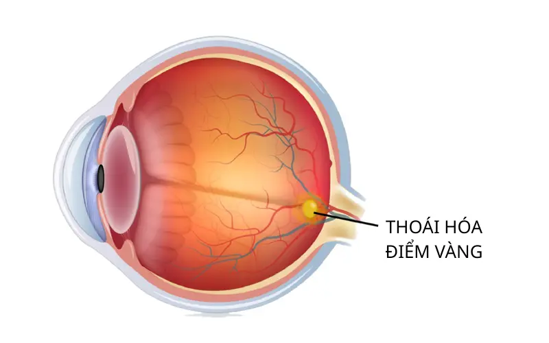 Thoái hóa điểm vàng là gì? Dấu hiệu, nguyên nhân và cách điều trị
