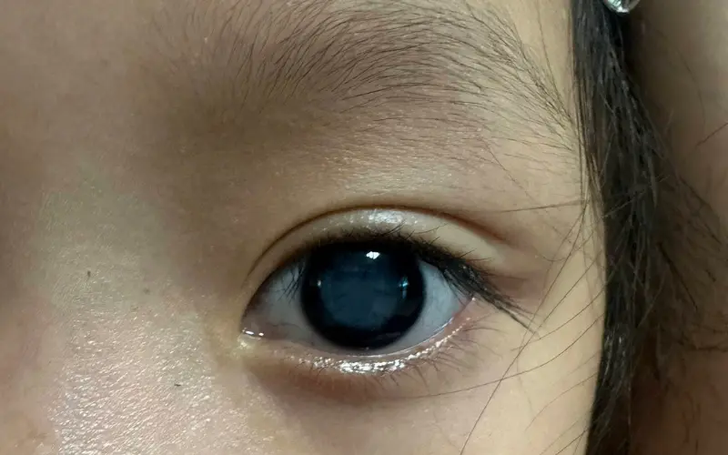 Trẻ em có bị đục thủy tinh thể không? Những điều cha mẹ cần biết