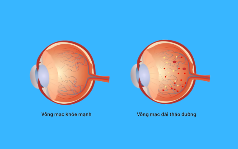 7 triệu chứng bệnh võng mạc tiểu đường chớ nên chủ quan