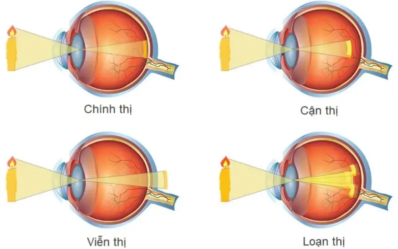 tình trạng cận thị và viễn thị