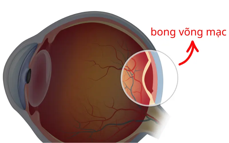 Bong võng mạc do cận thị: Dấu hiệu, nguy cơ và cách điều trị