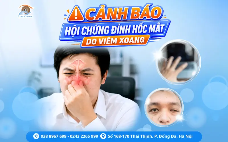 MỜ MẮT, SỤP MI: CẢNH BÁO HỘI CHỨNG ĐỈNH HỐC MẮT DO VIÊM XOANG