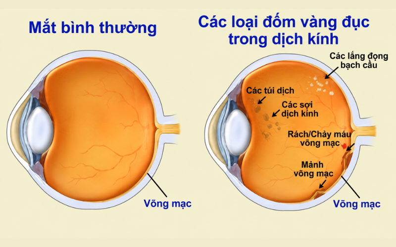Vẩn đục dịch kính là gì? Triệu chứng, nguyên nhân và điều trị